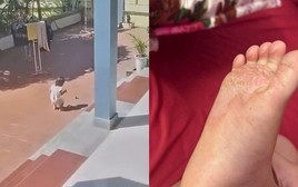 Cảnh báo các mẹ đừng chủ quan: Bé gái chạy chân trần ra sân nắng khiến lòng bàn chân bị bỏng rộp nặng, tróc da mảng lớn