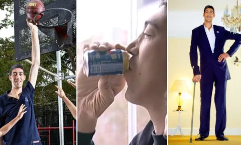 Bí ẩn căn bệnh khiến người đàn ông biến thành gã khổng lồ