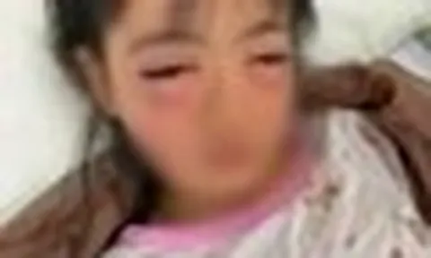 Bé 5 tuổi la hét đau đớn sau vài phút chơi bong bóng xà phòng, mẹ lên bài cảnh báo các phụ huynh