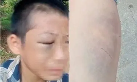 Quyết định của thầy hiệu trưởng trong vụ bé trai nghi bị bạo hành khi sống cùng bố và mẹ kế