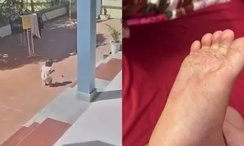 Cảnh báo các mẹ đừng chủ quan: Bé gái chạy chân trần ra sân nắng khiến lòng bàn chân bị bỏng rộp nặng, tróc da mảng lớn