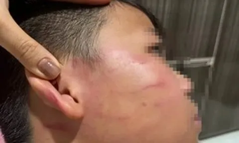 Vụ giáo viên nước ngoài tát học sinh: Gia đình nói bé trai bị thủng màng nhĩ