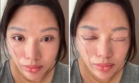 Phẫu thuật mí mắt hỏng, nạn nhân còn bị kiện ngược