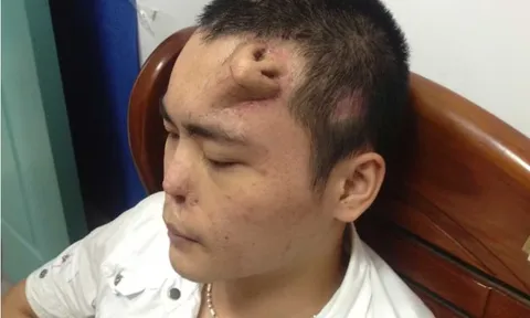 Người đàn ông có chiếc mũi "mọc" giữa trán, sự thật phía sau gây bất ngờ