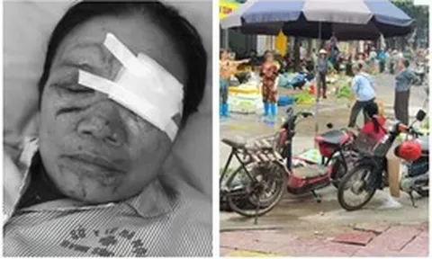 Người phụ nữ bán rau bị xịt nước, chảy máu mắt ở Phú Thọ: Con trai lên tiếng, mong làm rõ trách nhiệm