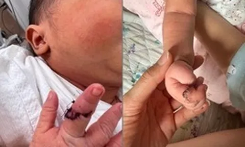 Chia sẻ của 1 sản phụ Việt tại Nhật Bản: Con gái vừa chào đời bị bác sĩ cắt trúng tay, nguy cơ di chứng lâu dài